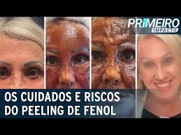 Peeling de fenol