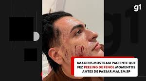 Exclusivo: Domingo Espetacular fala com esteticista que aplicou peeling de fenol em empresário